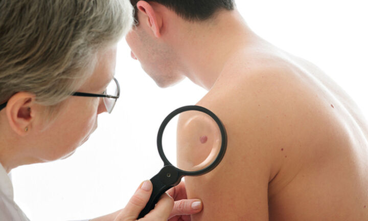  Περίπου 7,3 εκατομμύρια Ευρωπαίοι έχουν καρκίνο του δέρματος
